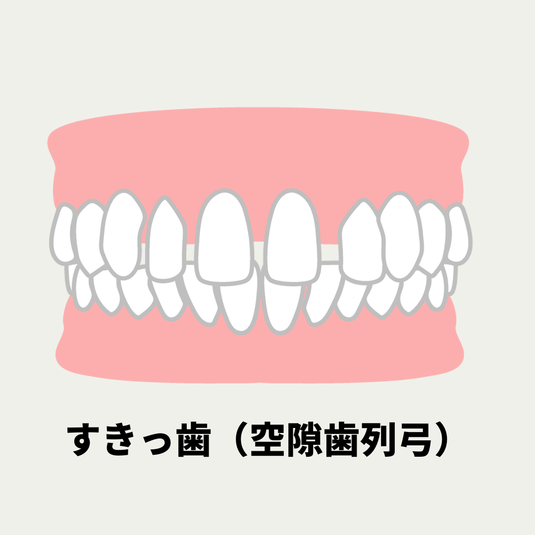 すきっ歯になる原因と治し方 | ささくら矯正歯科クリニック | 新潟市中央区の矯正歯科クリニック